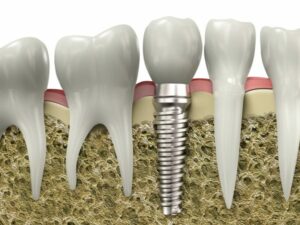 Dental Implants Algonquin, Carpentersville, and Huntley