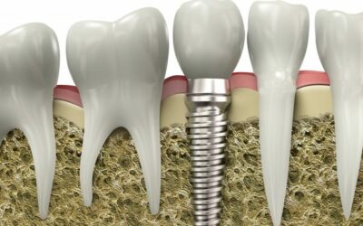 Advantages of Dental Implants