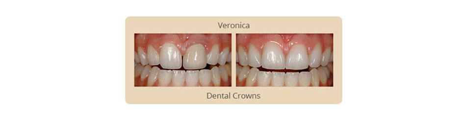 Dental Crowns