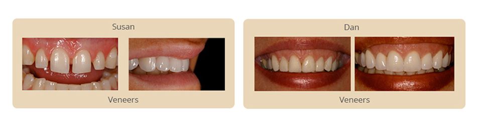 Porcelain Veneers Algonquin