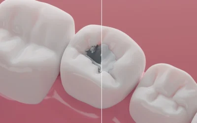 Why Remove Mercury Tooth Fillings?